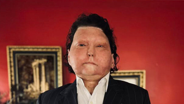 “Port fața și mâinile altcuiva”. Primul om cu transplant de față și mâini povestește cum a supraviețuit tragediei care i-a ars 80% din piele