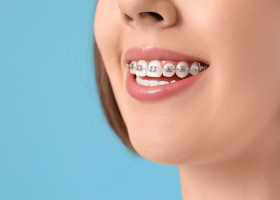 Young woman with dental braces on blue background, closeup