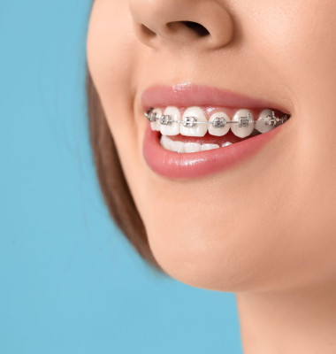 Young woman with dental braces on blue background, closeup