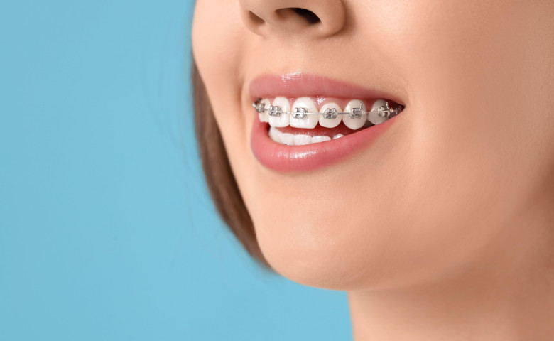 Young woman with dental braces on blue background, closeup