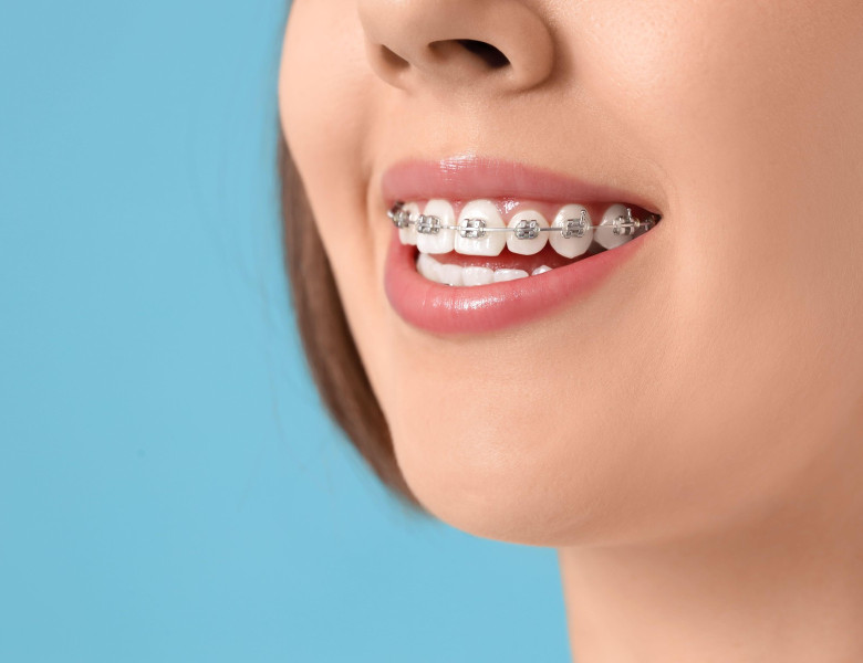 Young woman with dental braces on blue background, closeup