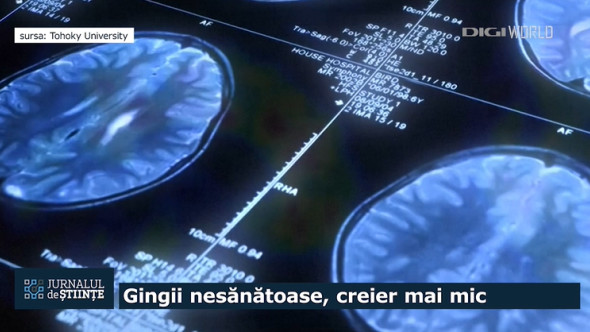 Legătura neașteptată dintre gingii și creier. Boala gingivală poate accelera îmbătrânirea unei zone esențiale