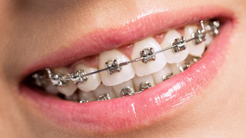 aparat dentar