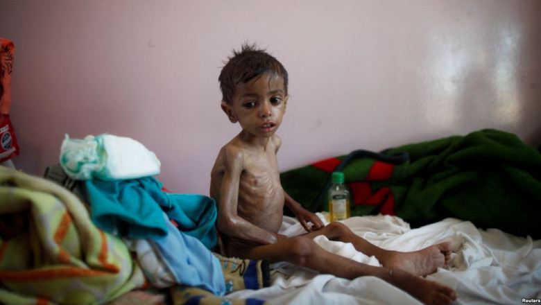 Copil malnutrit în Yemen
