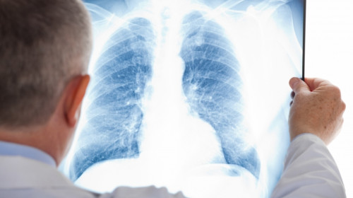 Radiografie pulmonară, doctor, tuberculoză, TBC