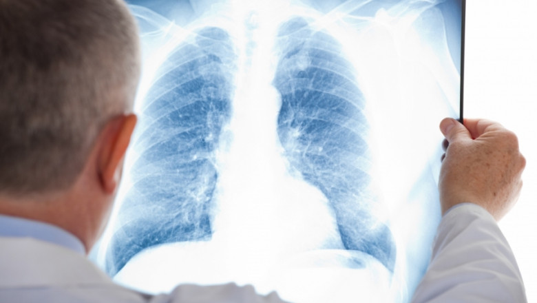 Radiografie pulmonară, doctor, tuberculoză, TBC