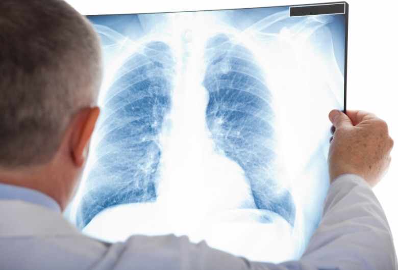 Radiografie pulmonară, doctor, tuberculoză, TBC