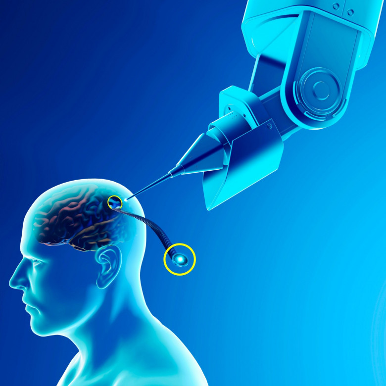 Link, neuralink, new artificial intelligence technology that allows you to connect to the human brain. Neuralink sensors ready to be installed