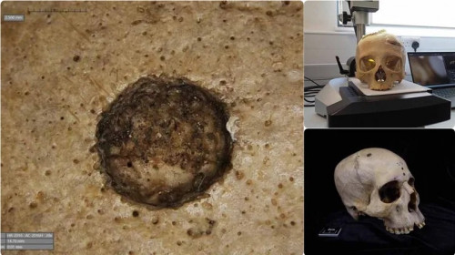 craniu din antichitate cu cancer