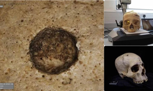 craniu din antichitate cu cancer