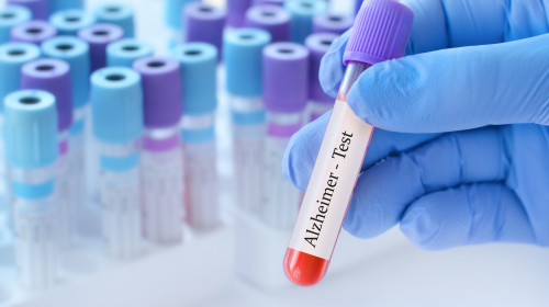 Doctor,Holding,A,Test,Blood,Sample,Tube,With,Alzheimer,Test