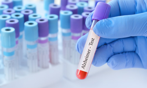 Doctor,Holding,A,Test,Blood,Sample,Tube,With,Alzheimer,Test