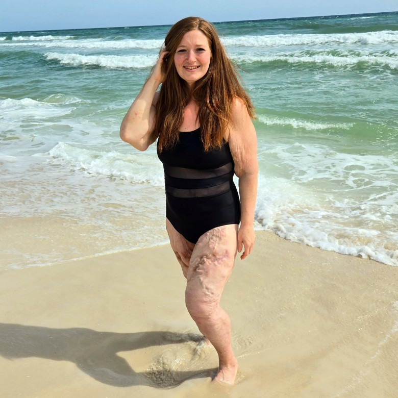 Woman who dropped 310lbs WITHOUT fat jabs after feeling like 'prisoner' in own body proudly shows off excess skin in swimwear but still CAN'T go swimming
