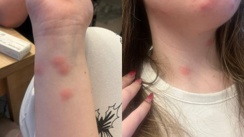 Tânără de 24 de ani, mușcată de ploșnițe într-un tren București–Sighet/ Foto: Facebook/Europa FM