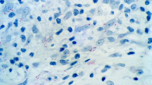 Leprosy: skin biopsy