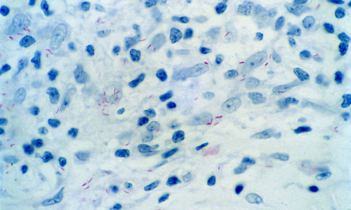 Leprosy: skin biopsy