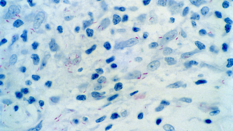 Leprosy: skin biopsy