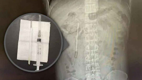 Ce au descoperit medicii în stomacul unui bărbat internat cu dureri abdominale groaznice/ Foto: X