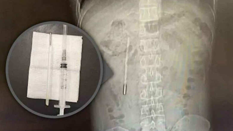 Ce au descoperit medicii în stomacul unui bărbat internat cu dureri abdominale groaznice/ Foto: X