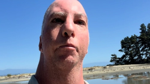 Influencer with 'Birdman syndome' who beat the odds reveals doctors said he 'wouldn't live past 24 hours'