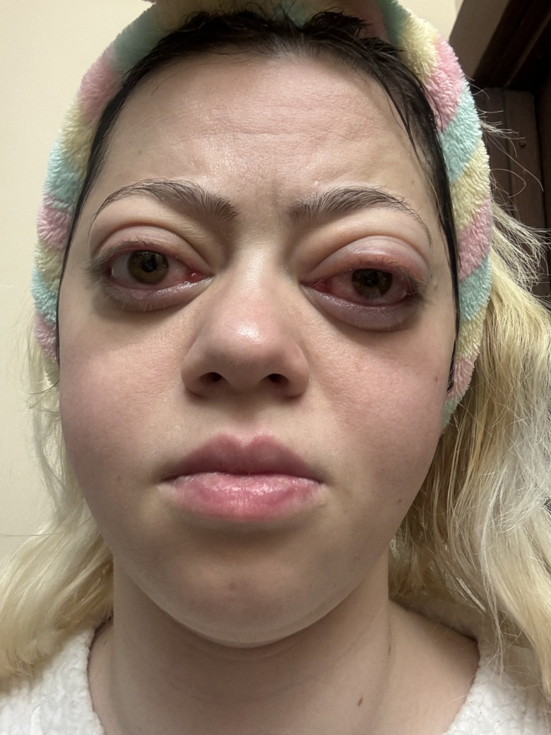 ‘Doctors said it was just allergies – but my bulging eyes turned out to be a rare disease that left me hospitalised almost 50 times’
