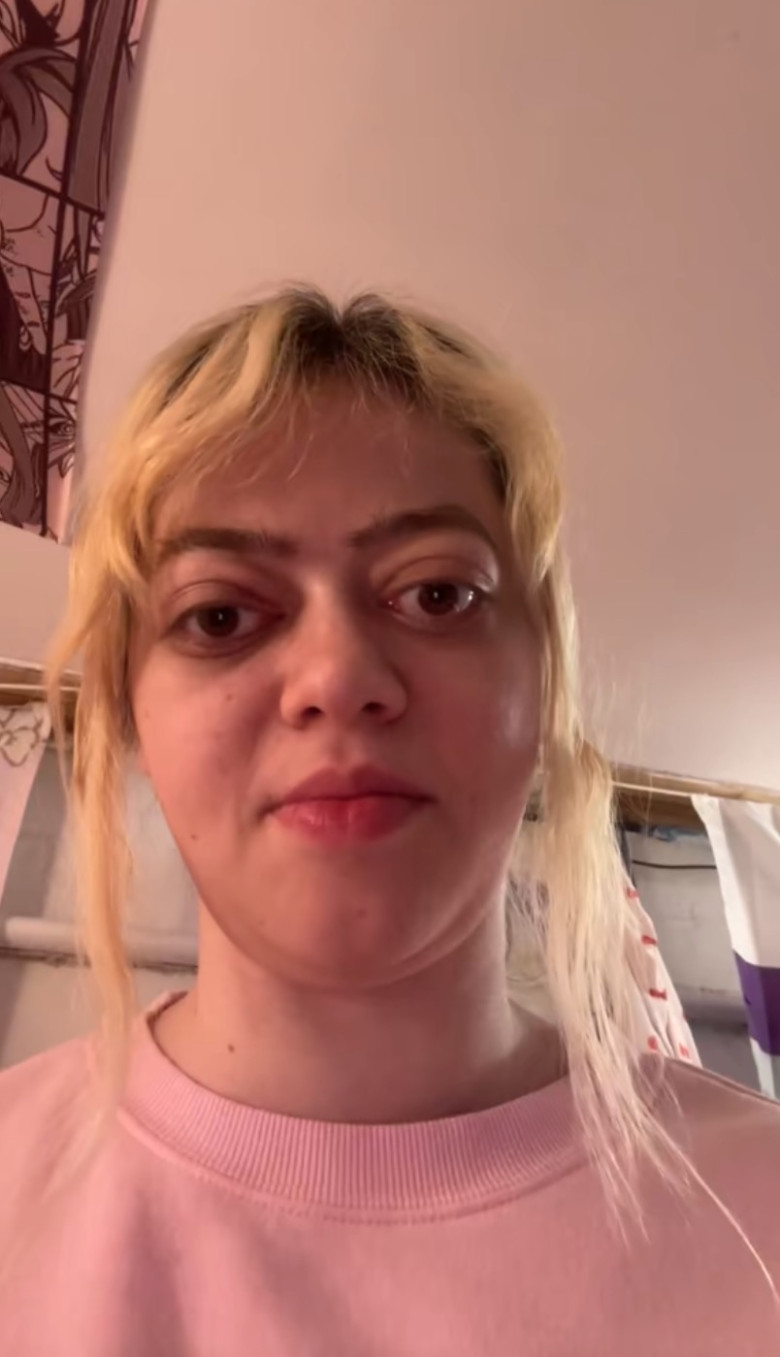 ‘Doctors said it was just allergies – but my bulging eyes turned out to be a rare disease that left me hospitalised almost 50 times’