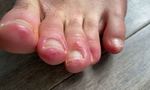 Degete degerate la picioare, degete COVID, coronavirus