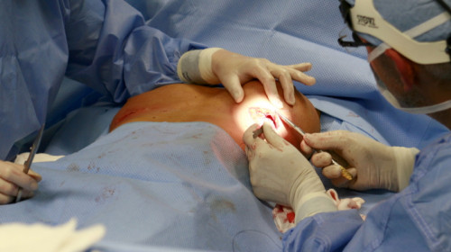 Operație la sâni, chirurgie estetică, intervenție chirurgicală, medic, doctor, implant mamar