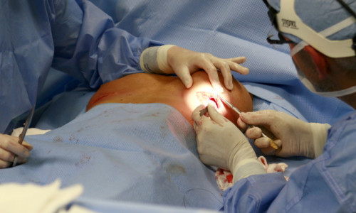 Operație la sâni, chirurgie estetică, intervenție chirurgicală, medic, doctor, implant mamar