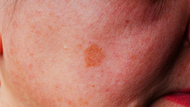 Alunițe pe față, cancer de piele, risc de expunere prelungită la soare