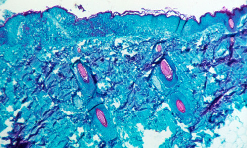 Monkey skin tissue infected with monkeypox virus