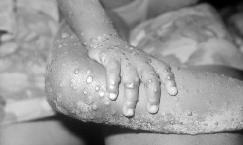 Monkeypox infection, 1971