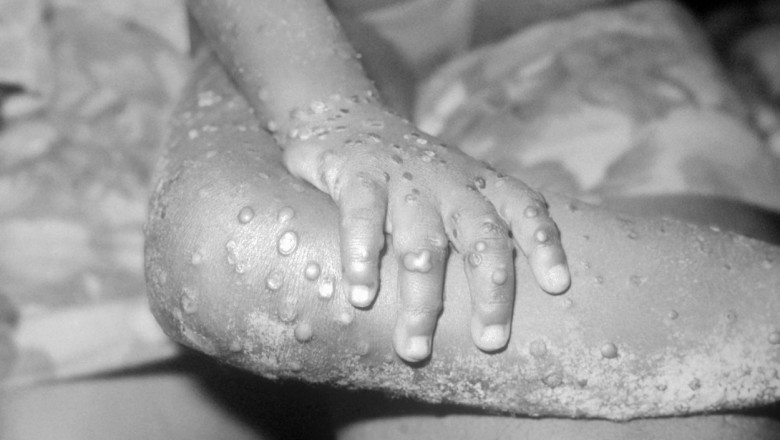Monkeypox infection, 1971