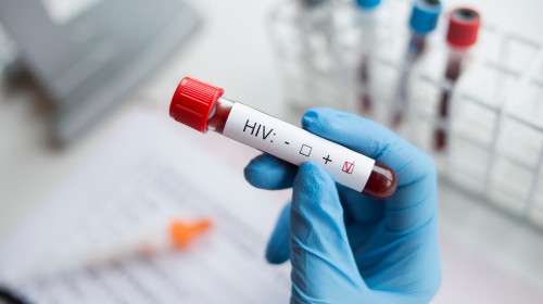 Peste 17.500 de persoane din România sunt infectate cu HIV. Calea de transmitere principală rămâne calea heterosexuală/ Shutterstock