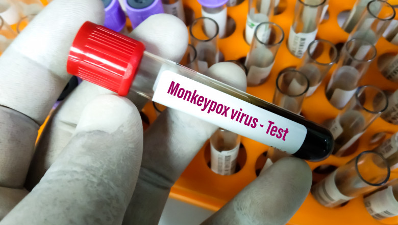 Un nou caz de variola maimuţei a fost confirmat în România/ Shutterstock