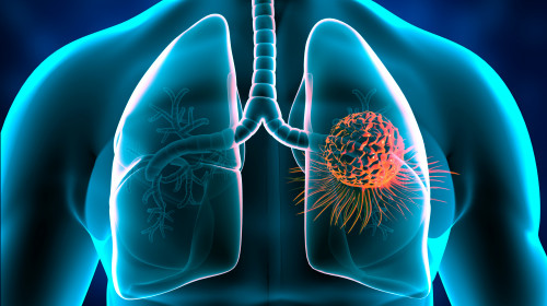 Lungs,Cancer,,Tumor,In,Lungs.,3d,Illustration