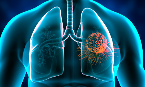 Lungs,Cancer,,Tumor,In,Lungs.,3d,Illustration
