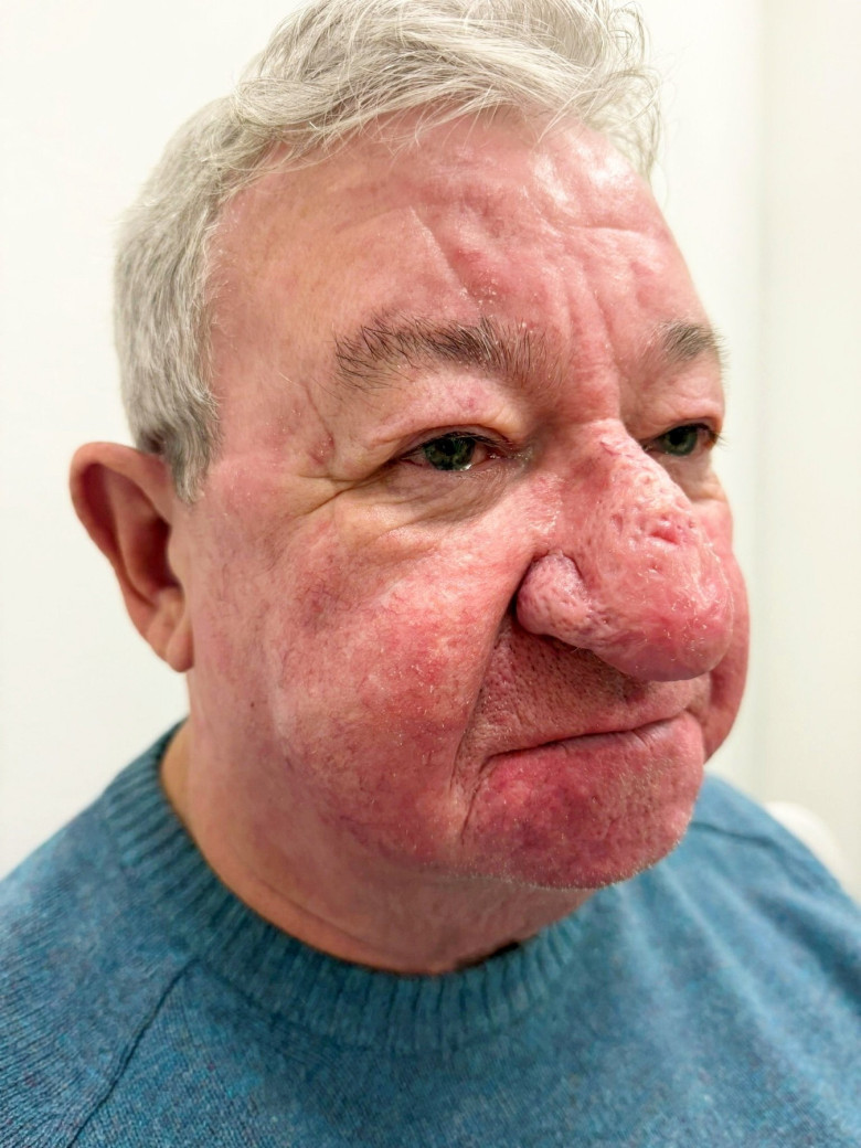 Man left unable to kiss his wife after one of the "worst cases" of nose swelling