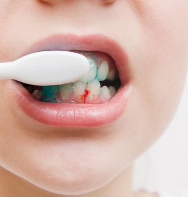 Sângerarea gingiilor nu e doar de la periaj/ Profimedia