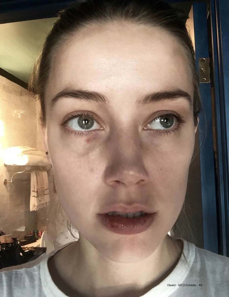 Johnny Depp admits to accidentally headbutting Amber Heard as High Court hearing is shown photos of her injuries from 2015 altercation