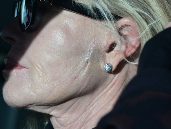 EXCLUSIVE: Melanie Griffith, Star Of 'Nip/Tuck' Displays Recent Scar On The Left Side Of Her Face As She Is Spotted In West Hollywood, CA