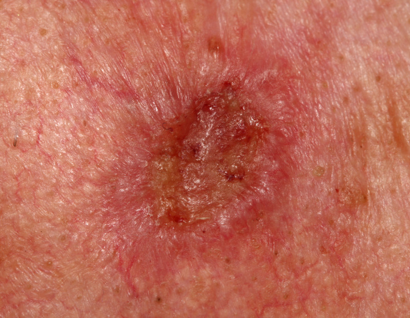 cancerul de piele tratament