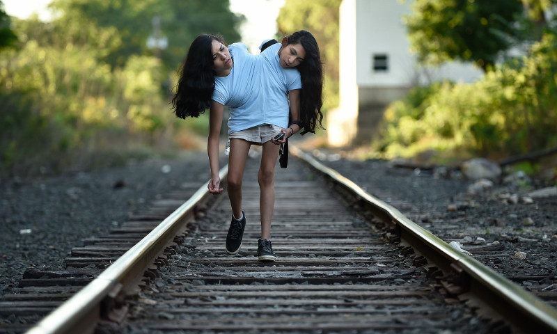 Rare conjoined twins seek ordinary life in extraordinary circumstances