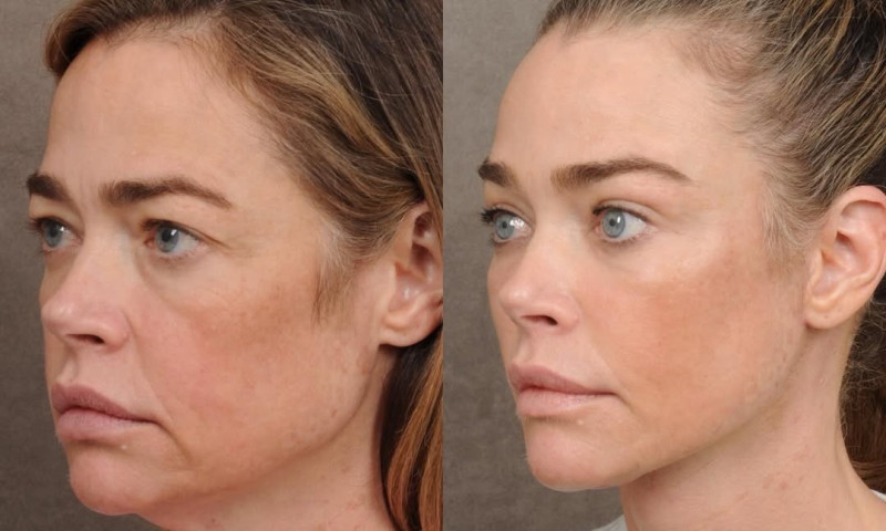 Denise Richards, de nerecunoscut după ce și-a făcut un lifting facial/ Foto: Instagram