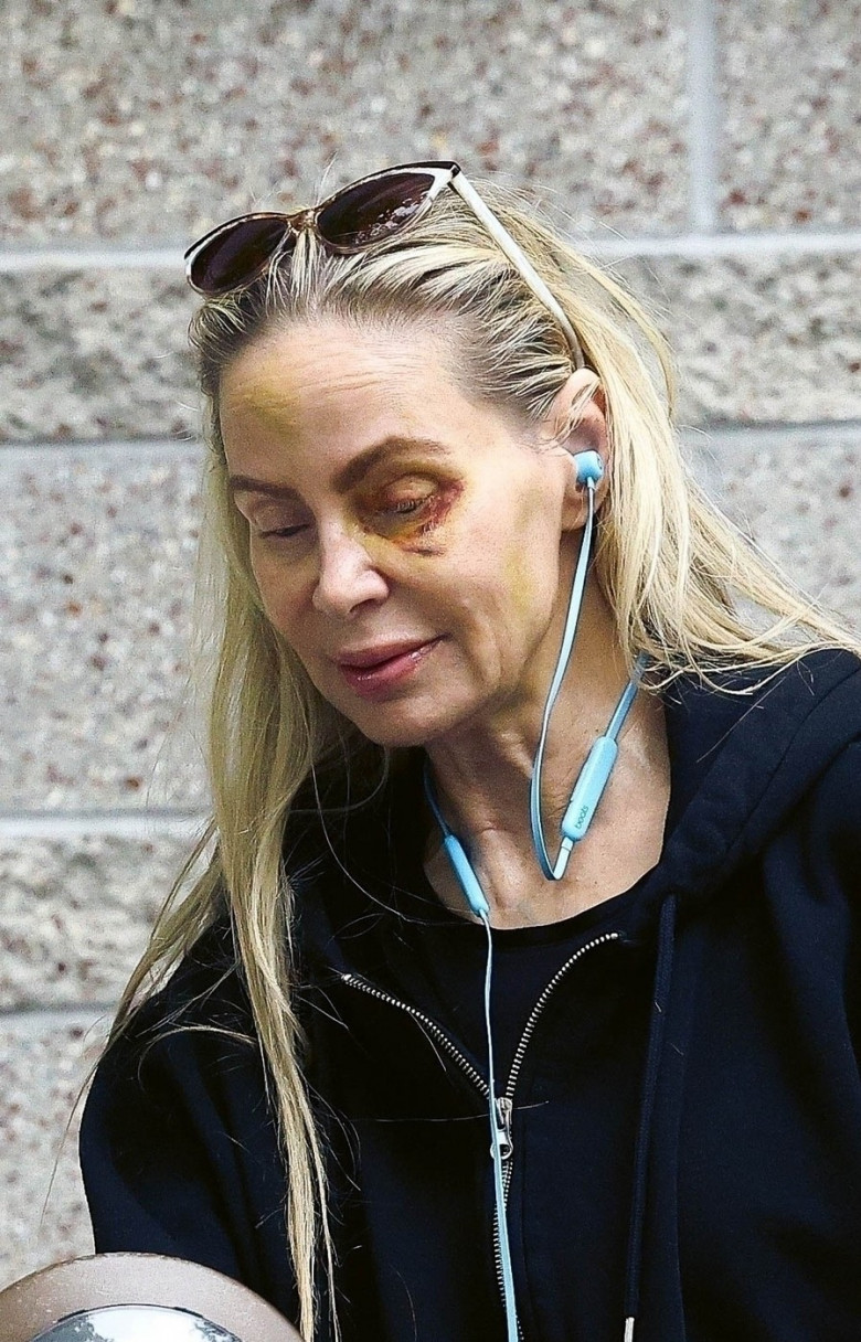 *PREMIUM-EXCLUSIVE* Christina Fulton sports a black eye during an outing with a mystery man in LA