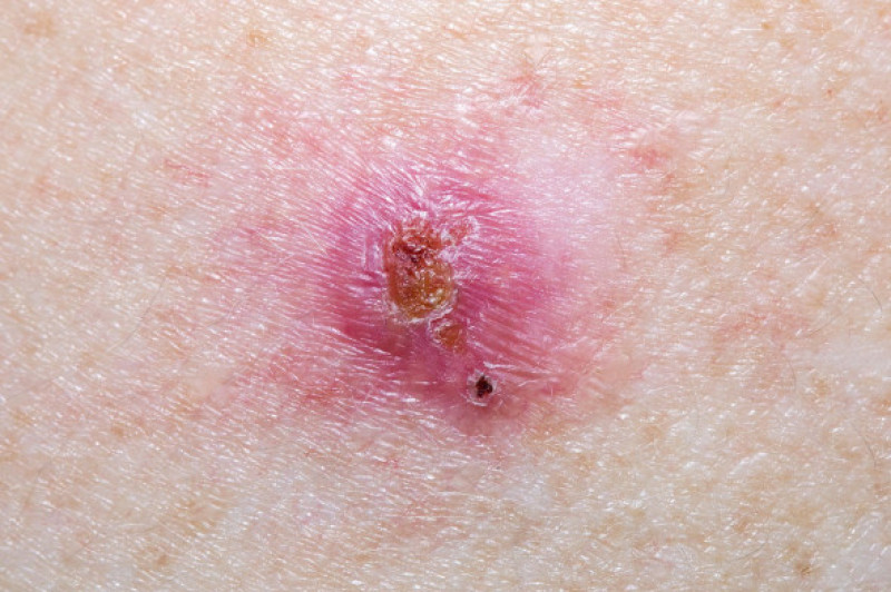 carcinom bazocelular