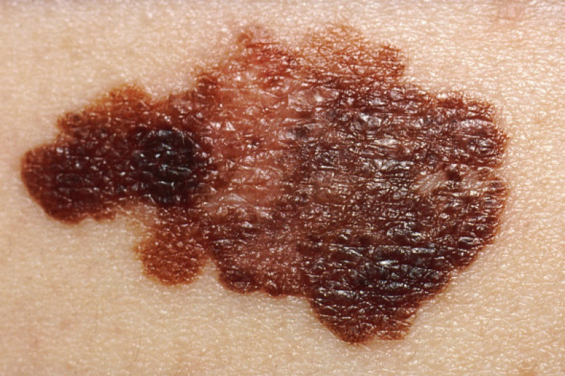 Melanom, cancer de piele