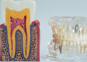 Cum îi afectează fumatul pe oamenii care-și fac implanturi dentare. Și cei cu dinți naturali au de suferit