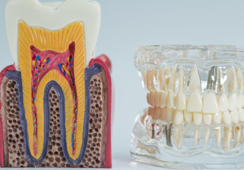 Cum îi afectează fumatul pe oamenii care-și fac implanturi dentare. Și cei cu dinți naturali au de suferit