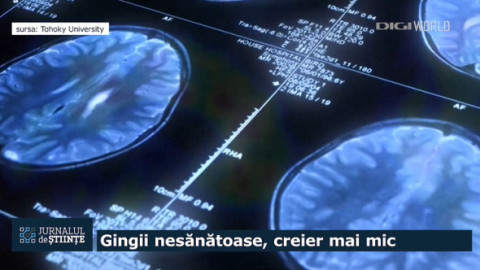 Legătura neașteptată dintre gingii și creier. Boala gingivală poate accelera îmbătrânirea unei zone esențiale